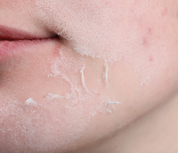 Dryness and Peeling