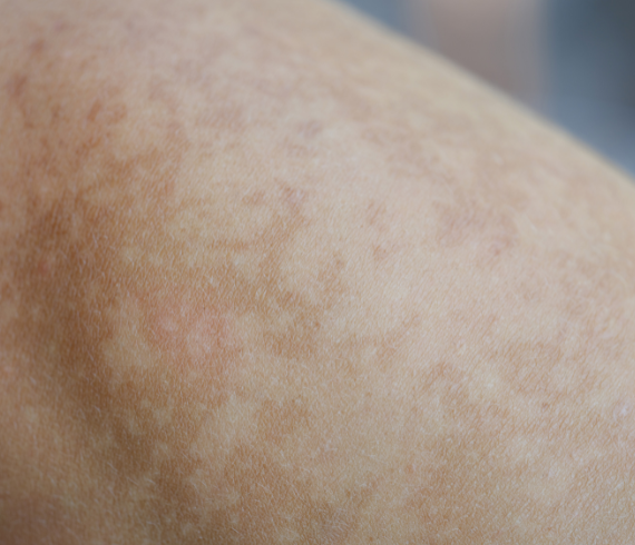 Uneven Skin Tone